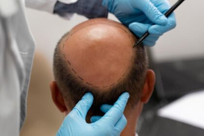 Implantes capilares en Chile: ¿en qué consisten y cuánto cuesta hacerse uno?