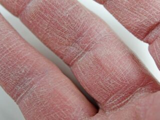 ¿Por qué la piel se reseca más en invierno y cómo prevenirlo eficazmente?
