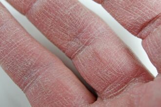 ¿Por qué la piel se reseca más en invierno y cómo prevenirlo eficazmente?