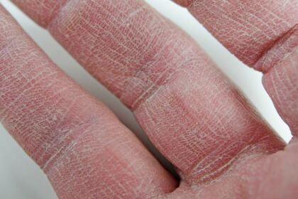 ¿Por qué la piel se reseca más en invierno y cómo prevenirlo eficazmente?